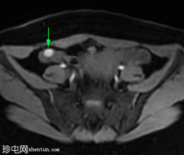 局灶性子宫腺肌病伴卵巢子宫内膜异位症