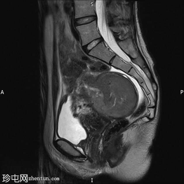 巧克力囊肿（子宫内膜异位症）和局灶性子宫腺肌病