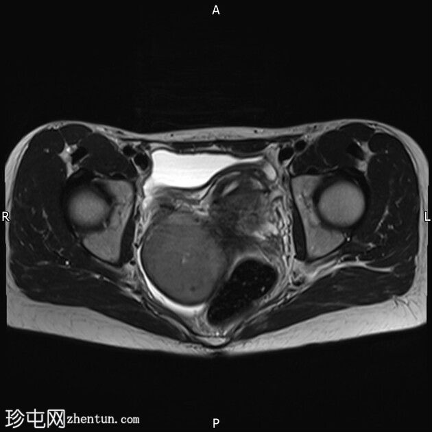 巧克力囊肿（子宫内膜异位症）和局灶性子宫腺肌病