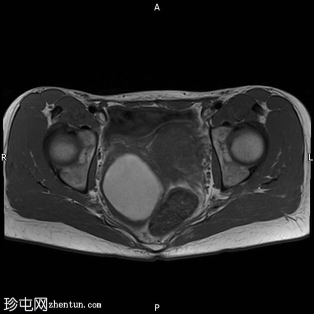 巧克力囊肿（子宫内膜异位症）和局灶性子宫腺肌病