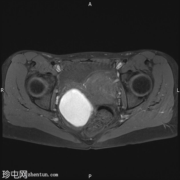 巧克力囊肿（子宫内膜异位症）和局灶性子宫腺肌病