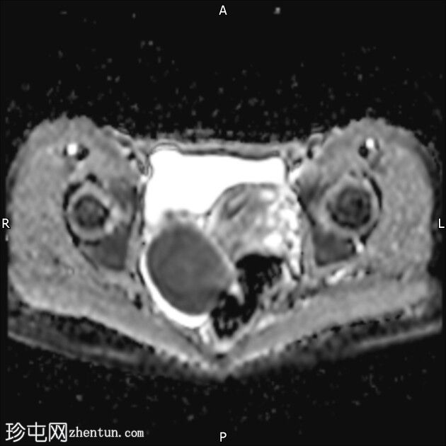 巧克力囊肿（子宫内膜异位症）和局灶性子宫腺肌病