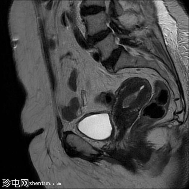 子宫内膜样腺癌