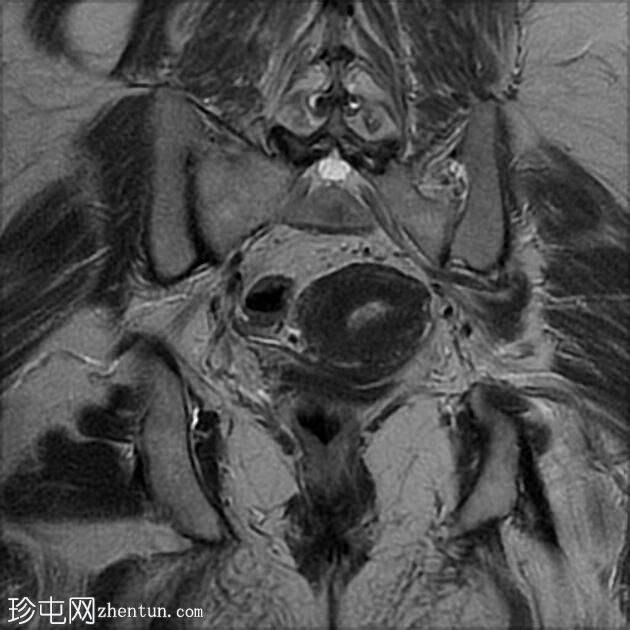 子宫内膜样腺癌