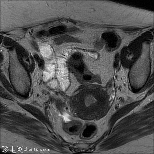 子宫内膜样腺癌