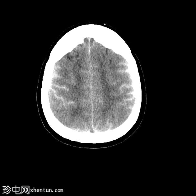 脊髓造影后脑 CT