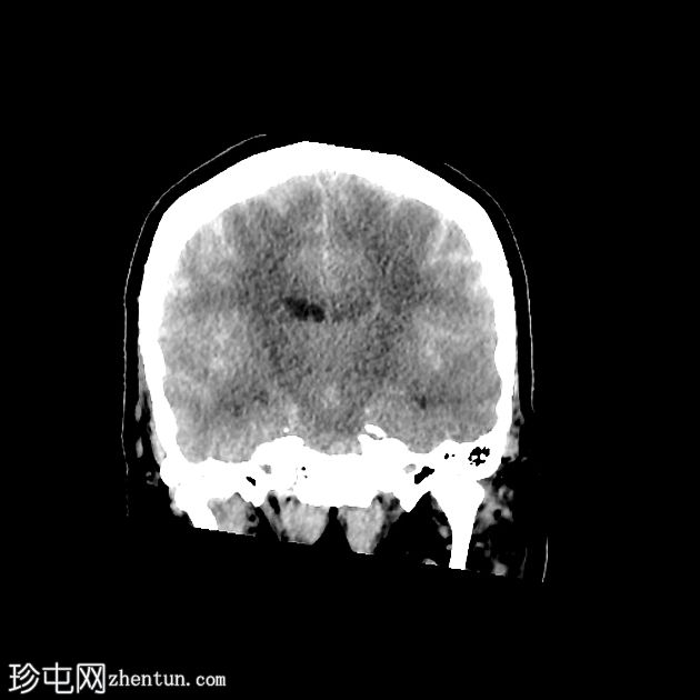 脊髓造影后脑 CT