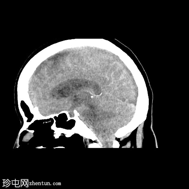 脊髓造影后脑 CT