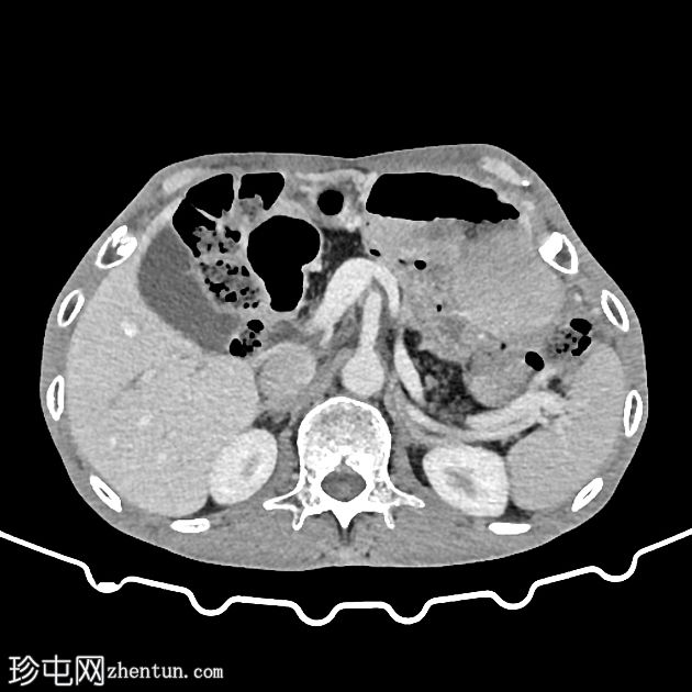 类固醇诱发的完全性胰腺脂肪瘤病