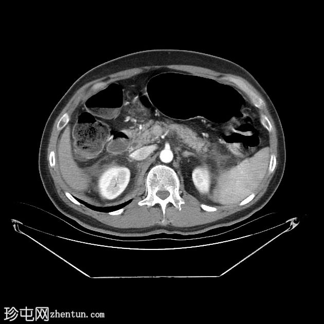 急性间质性胰腺炎