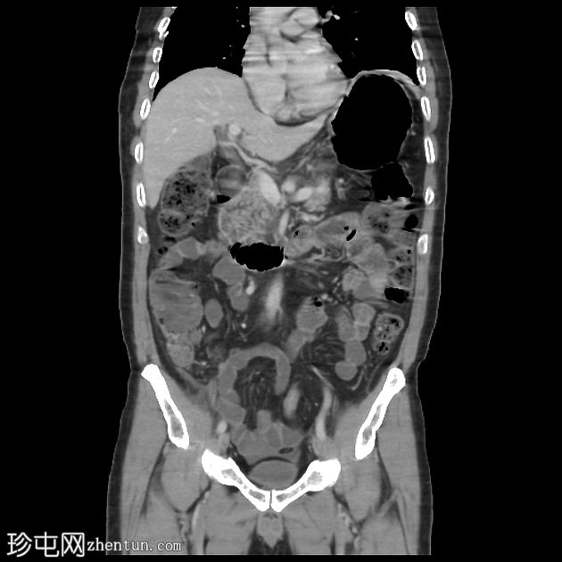 急性间质性胰腺炎