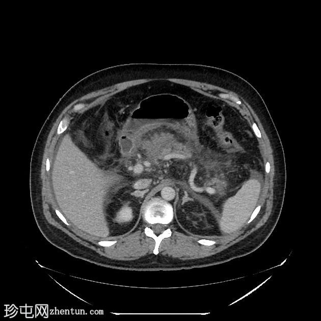 坏死性胰腺炎进展为包裹性坏死