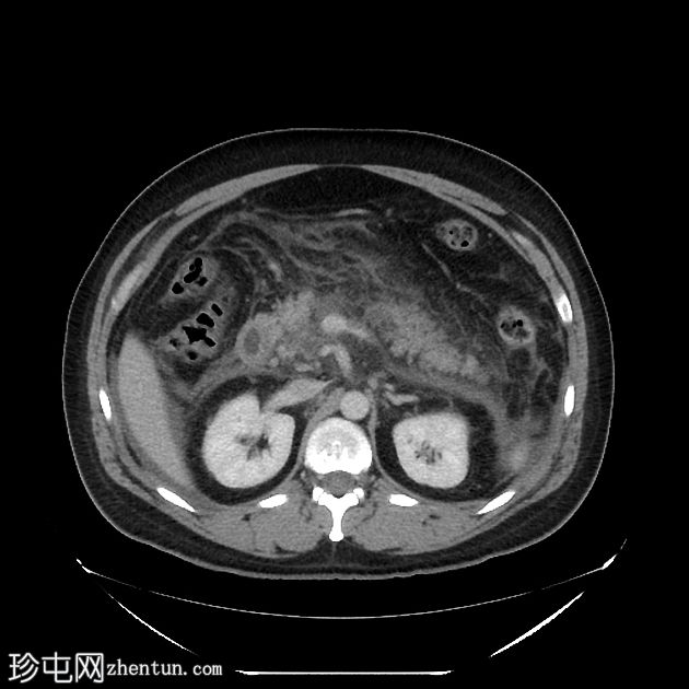 坏死性胰腺炎进展为包裹性坏死