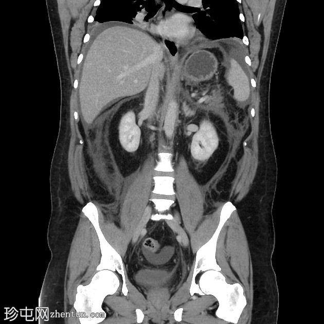 坏死性胰腺炎进展为包裹性坏死