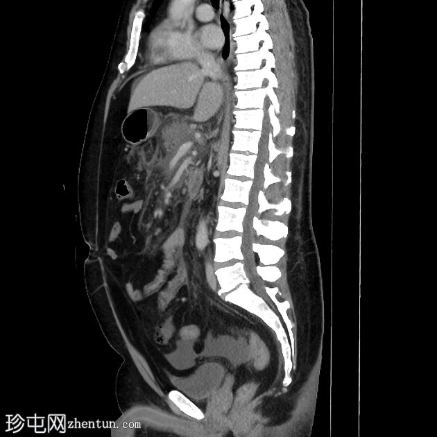 坏死性胰腺炎进展为包裹性坏死