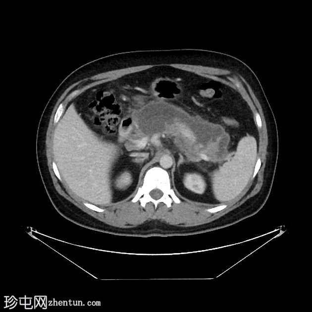 坏死性胰腺炎进展为包裹性坏死