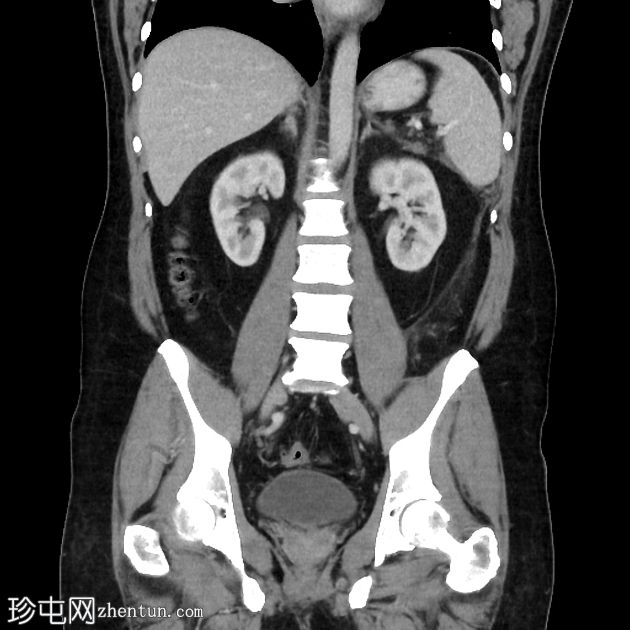 坏死性胰腺炎进展为包裹性坏死