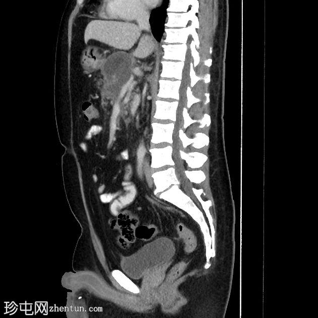 坏死性胰腺炎进展为包裹性坏死