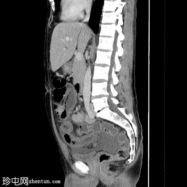 传染性小肠结肠炎