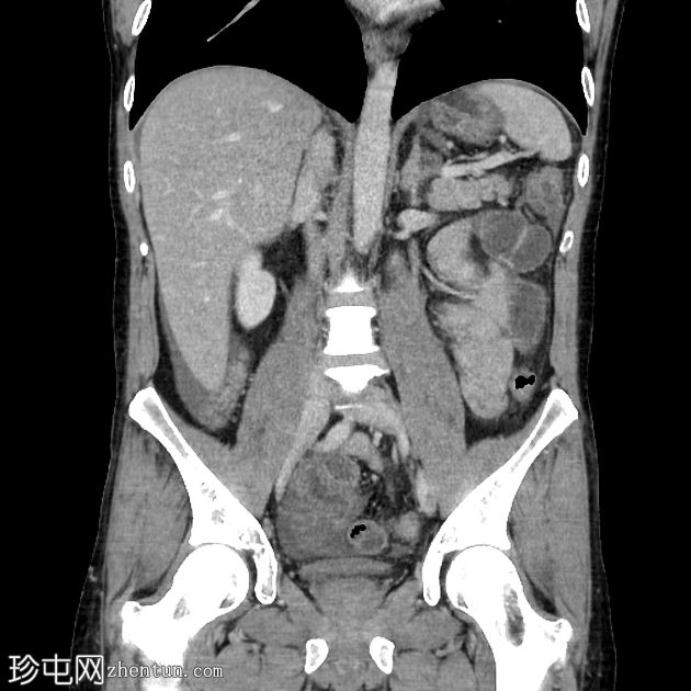 传染性小肠结肠炎