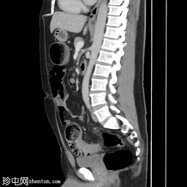 乙状结肠憩室狭窄引起阻塞