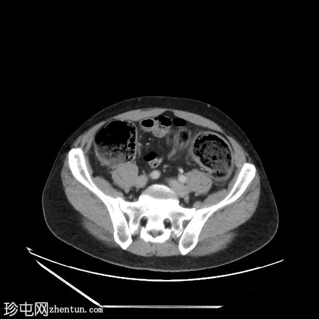 乙状结肠憩室狭窄引起阻塞