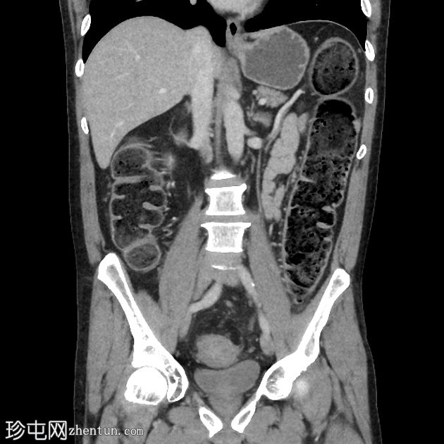 乙状结肠憩室狭窄引起阻塞