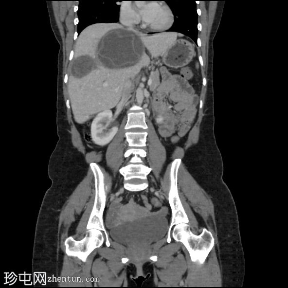 肝包虫囊肿