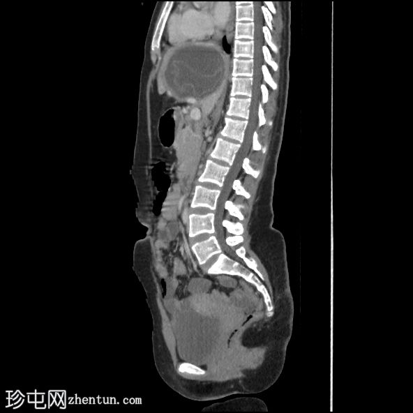 肝包虫囊肿