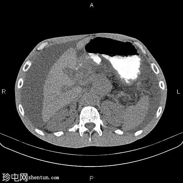 转移性胰腺导管腺癌