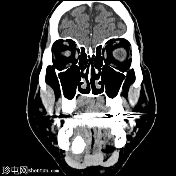 涎石症