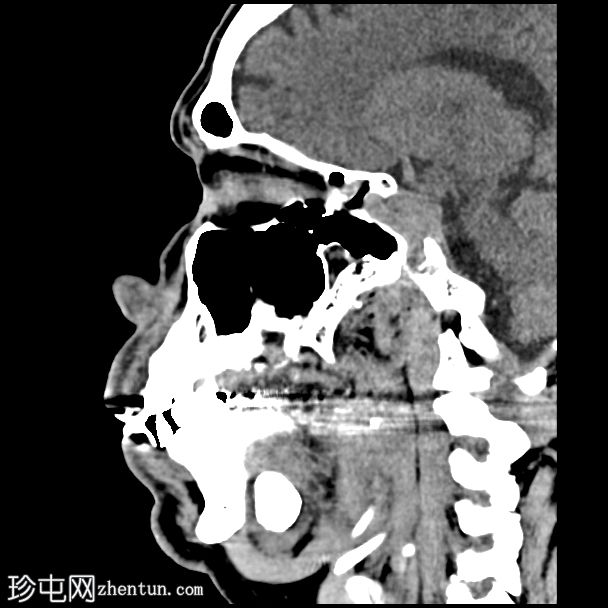 涎石症