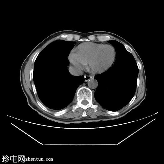 CT 引导下胸部活检-右肺肿块