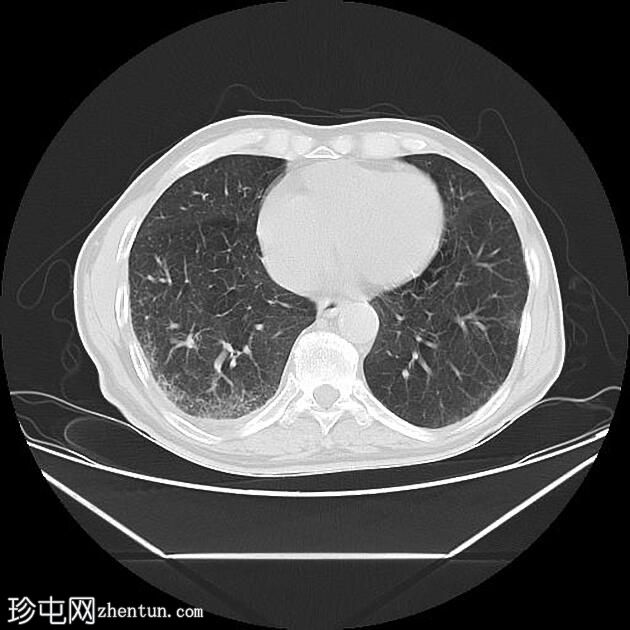 CT 引导下胸部活检-右肺肿块