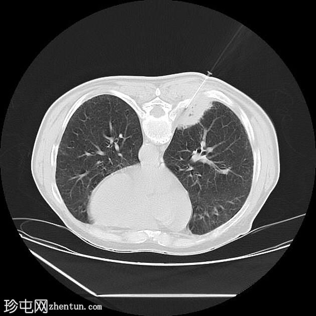 CT 引导下胸部活检-右肺肿块