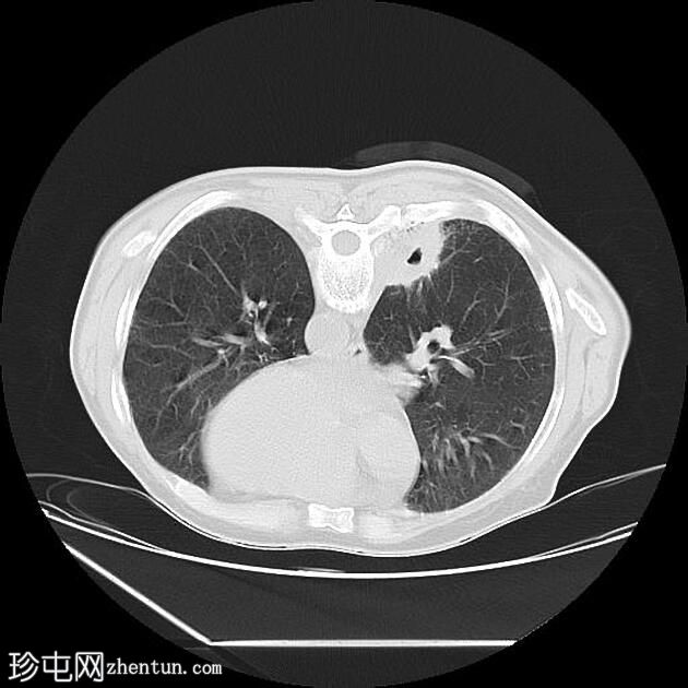 CT 引导下胸部活检-右肺肿块