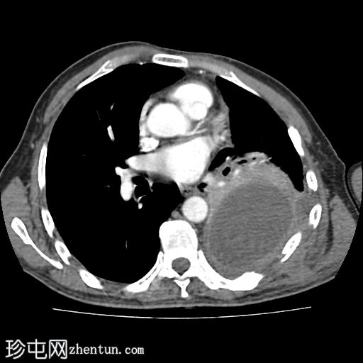 伴有“胸膜裂开”征的胸膜积脓