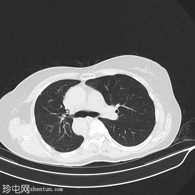 右侧主动脉弓有科莫雷尔憩室