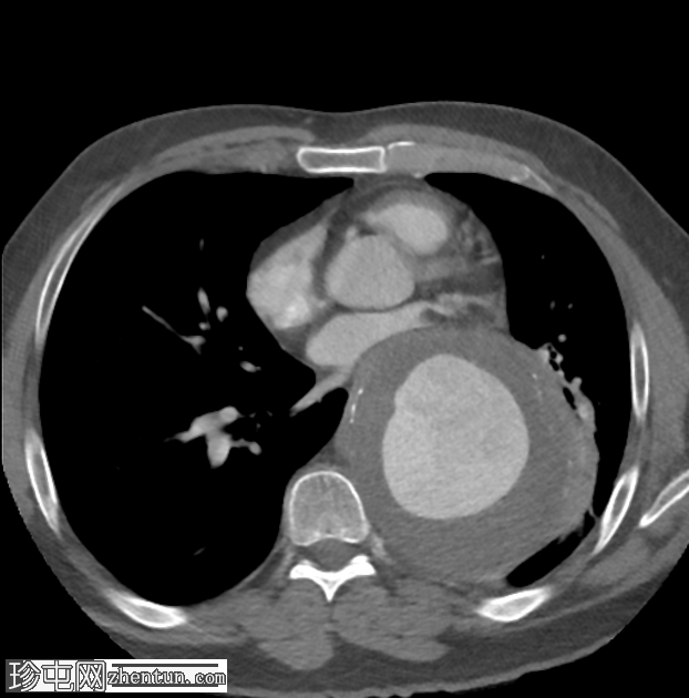 胸主动脉瘤
