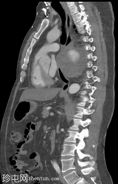 胸主动脉瘤
