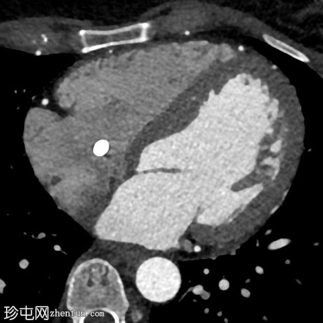 导管血栓和肺栓塞 (CTCA)