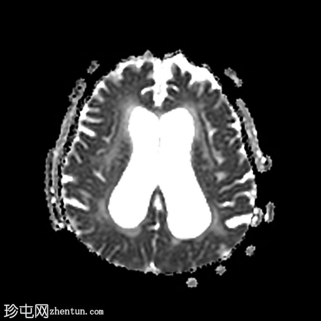 正常压力脑积水和淀粉样血管病