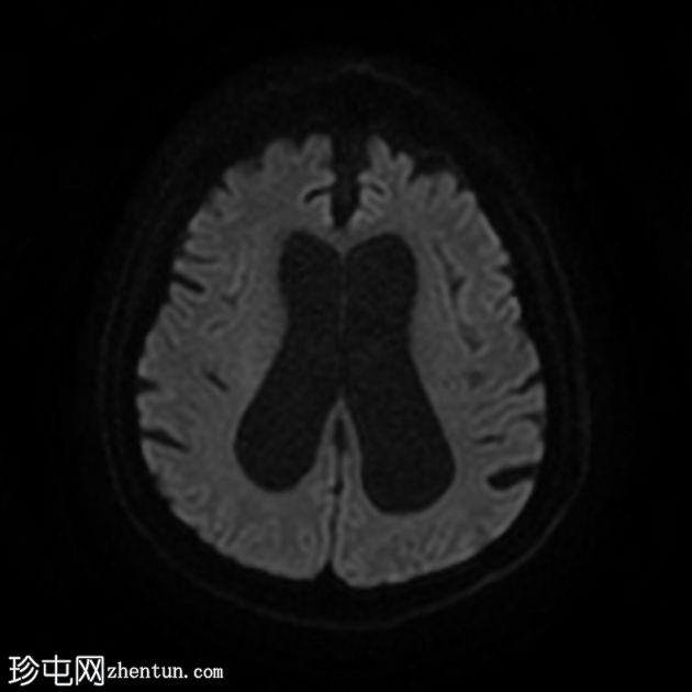 正常压力脑积水和淀粉样血管病