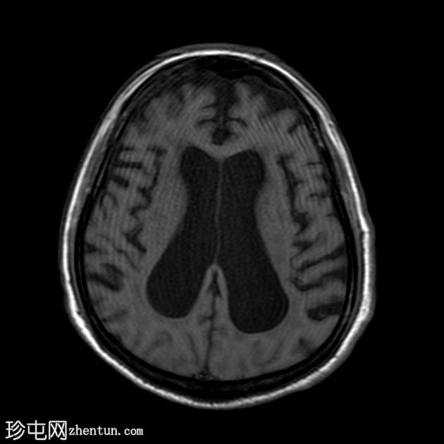 正常压力脑积水和淀粉样血管病