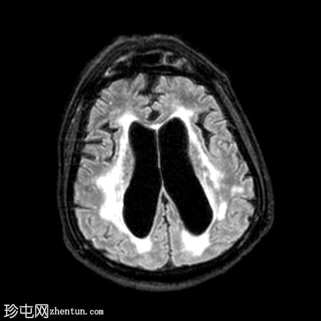 正常压力脑积水和淀粉样血管病