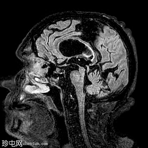 正常压力脑积水和淀粉样血管病