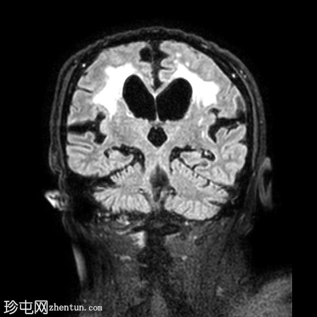 正常压力脑积水和淀粉样血管病