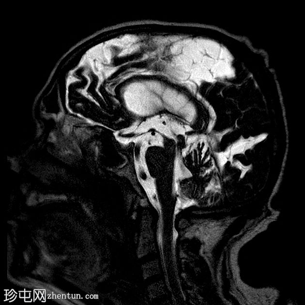 正常压力脑积水和淀粉样血管病