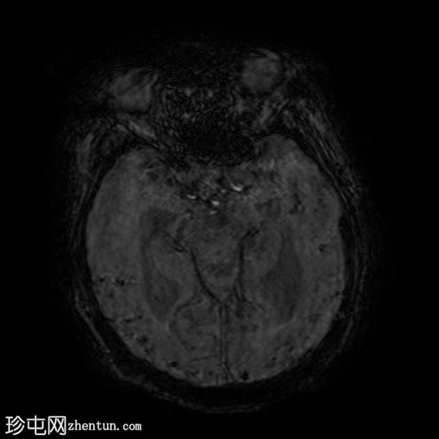 正常压力脑积水和淀粉样血管病