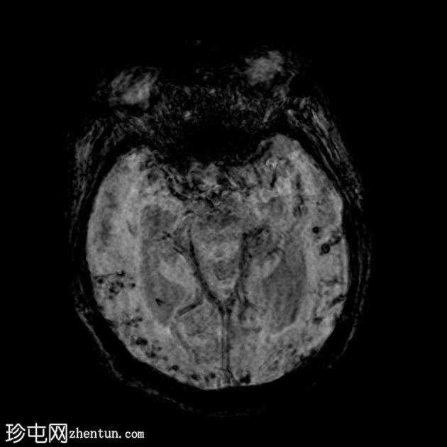 正常压力脑积水和淀粉样血管病